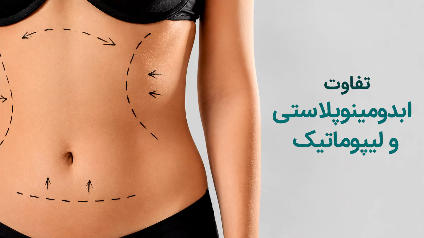 تفاوت آبدومینوپلاستی و لیپوماتیک