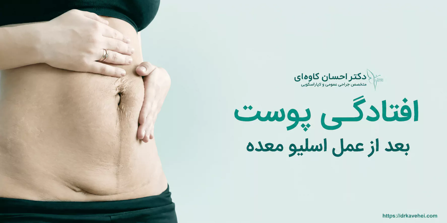 افتادگی پوست بعد از اسلیو معده