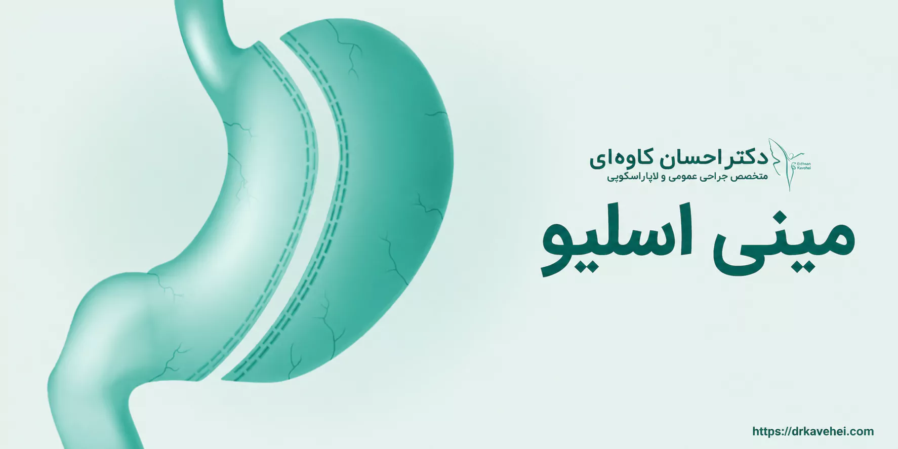 مینی اسلیو معده